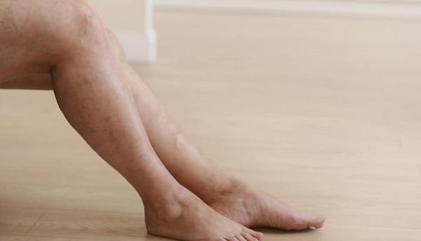 L'ensemble des preuves : La grossesse change de l'intérieur vers l'extérieur: photo de 2 jambes présentant des varices.